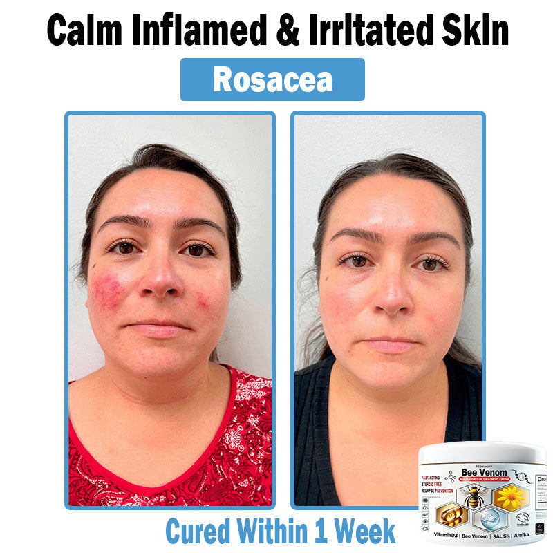 TO𝑫A𝐇OF®𝑩𝒆𝐞 𝑽𝐞𝒏𝒐𝒎 𝑴𝒖𝒍𝒕𝒊-𝑺𝒚𝒎𝒑𝒕𝒐𝒎 𝑺𝒌𝒊𝒏 𝑻𝒓𝐞𝒂𝒕𝒎𝒆𝒏𝒕 𝑪𝒓𝐞𝒂𝒎🌿