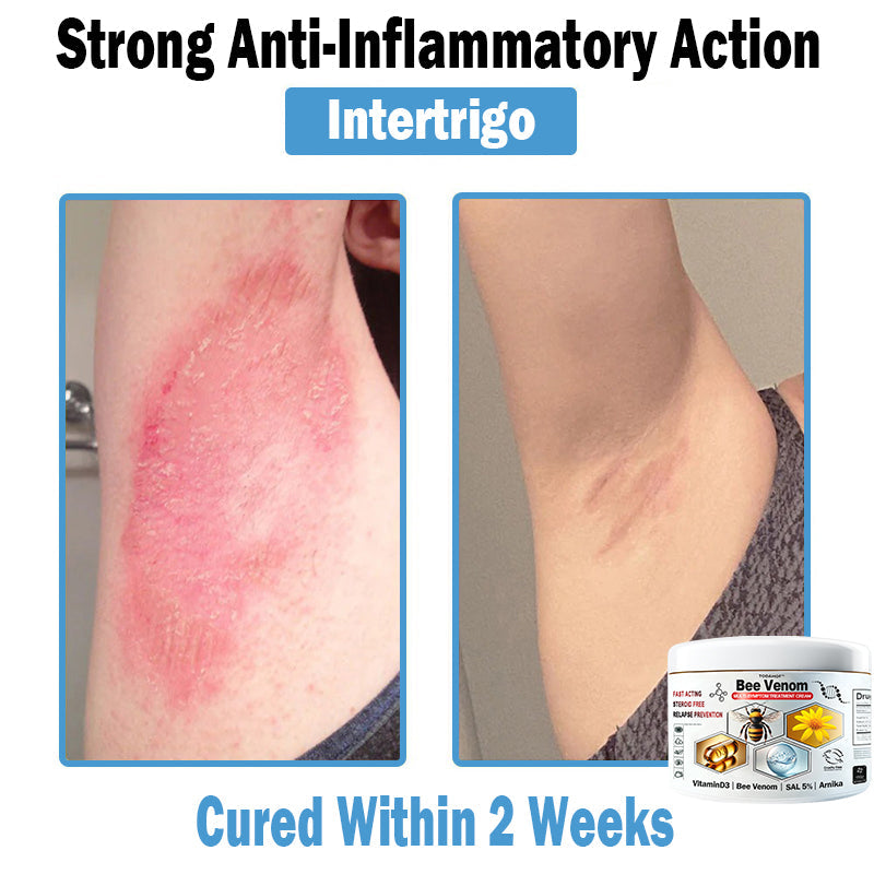 TO𝑫A𝐇OF®𝑩𝒆𝐞 𝑽𝐞𝒏𝒐𝒎 𝑴𝒖𝒍𝒕𝒊-𝑺𝒚𝒎𝒑𝒕𝒐𝒎 𝑺𝒌𝒊𝒏 𝑻𝒓𝐞𝒂𝒕𝒎𝒆𝒏𝒕 𝑪𝒓𝐞𝒂𝒎🌿